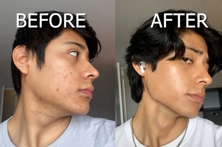 Cheek and jawline before and after 16 weeks of skin work